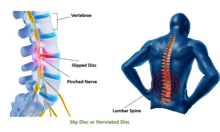 Slip Disc Treatment in Mumbai by Dr. Vishal Kundnani